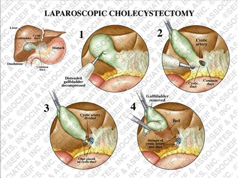 Laparoscopic Cholecystectomy Icu Nursing Nursing Notes Surgical Nursing