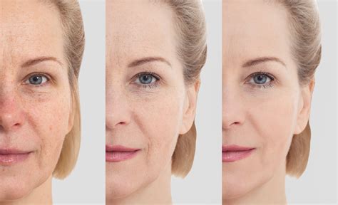 7 Ways To Get Rid Of Wrinkles A Step By Step Guide Sarmela Sunder Md