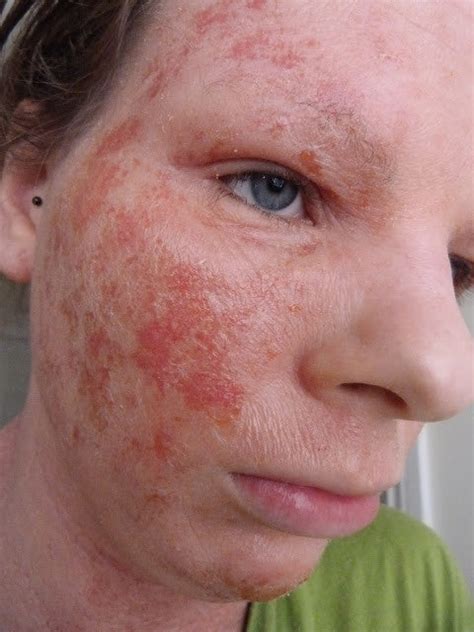 Guest Post Living With Adult Eczema Everything For Eczema