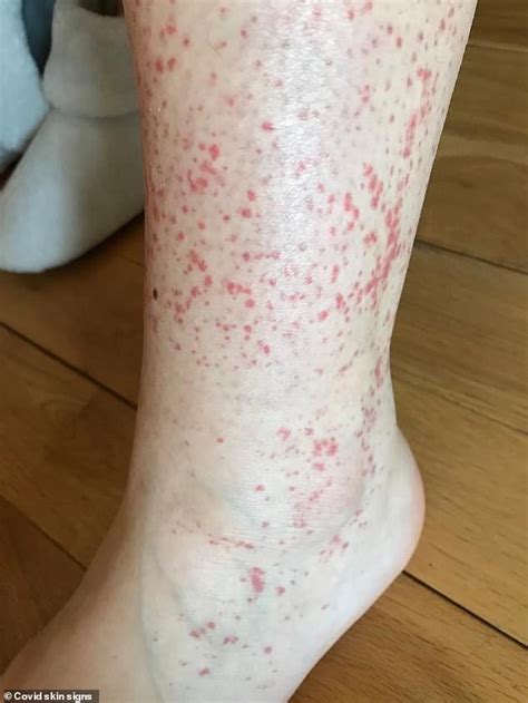 Covid Skin Rashes Are ONLY Symptom For Patients Says KCL Study