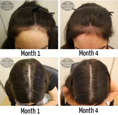 Watch belgravia centre client tom, who features in our advertising, talk openly about his experi. Hair Growth Success: "Great results would def recommend ...