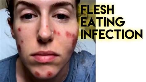 Flesh Eating Bacterial Infection In My Face Youtube