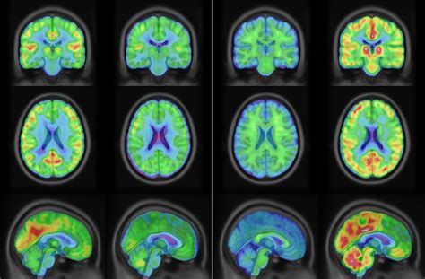 Clinical And Technical Considerations For Brain Pet Imaging For