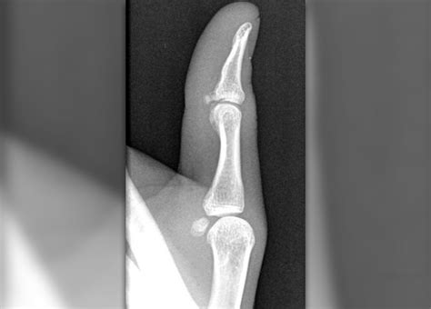Avulsion Fracture Injuries Fractures And Burns Articles Body