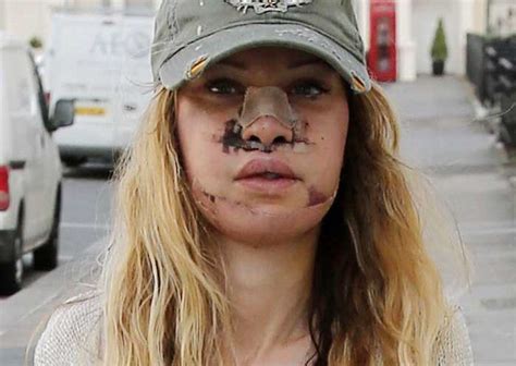 Chirurgie esthétique de stars ratée : Alicia Douvall : Les ratés de la chirurgie esthétique ...