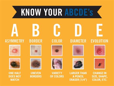 Spot The Differences Between A Mole And Skin Cancer