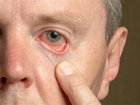 You and anyone you live with should stay at home and not have visitors until you. The eye symptom of a serious case of COVID-19 - Easy ...