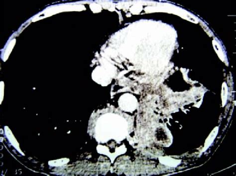 Chest Ct Necrosis And Consolidation On The Left Lower Lobe With
