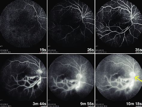 Serial Photographs Of Fundus Fluorescein Angiography Of The Re Shows