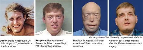 Face Transplant Gives New Hope To Mississippi Firefighter