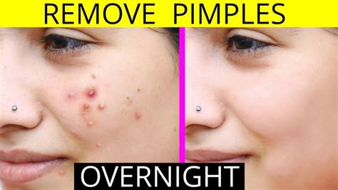 How To Remove Pimples Fast Naturally And Permanently Vel Illum