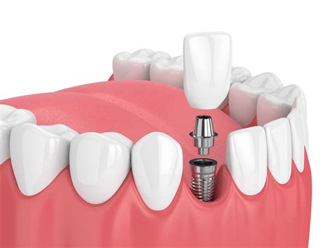 C Mo Se Colocan Los Implantes Dentales Zm Centro De Odontolog A