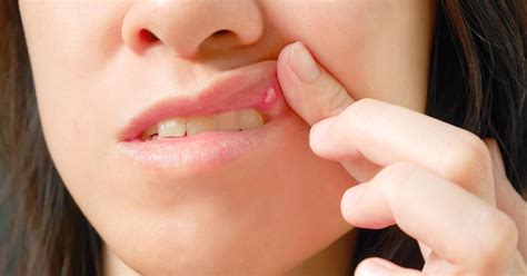 What Causes Canker Sores In Your Mouth And How Do They Heal