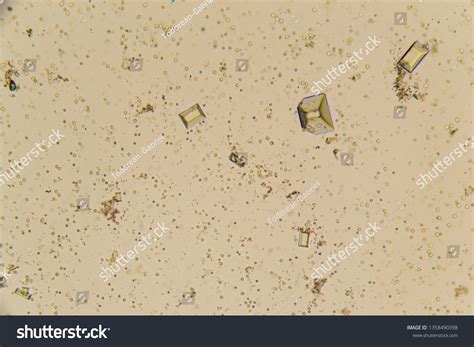 Urine Crystals Red Blood Cells Leukocytes Stock Photo 1358490398