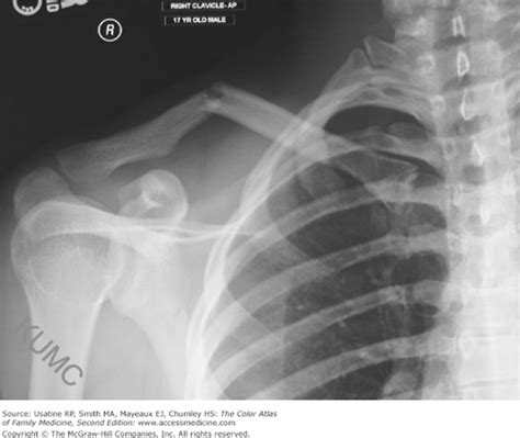 Clavicular Fracture Basicmedical Key