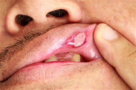 Maybe you would like to learn more about one of these? Como tratar a herpes para curar as feridas na boca mais ...