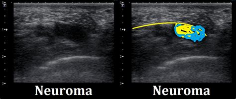 Ultrasound Images Of Neuromas Ankle Foot And Orthotic Centre