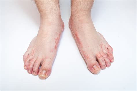 Cure Your Athletes Foot With Time Honored Remedies The Peoples Pharmacy