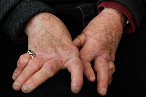 Psoriatic Arthritis On Hands Symptoms Pictures