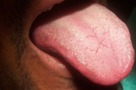 Picking Out Simple Solutions Of Candidiasis Sense45desert