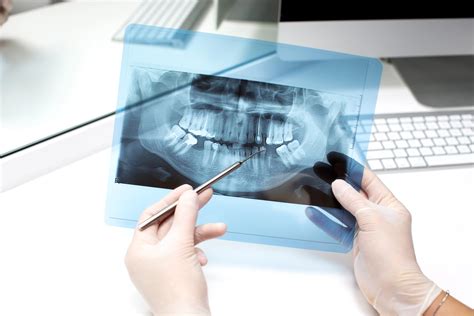 Tout Ce Que Vous Devez Savoir Sur Les Implants Dentaires