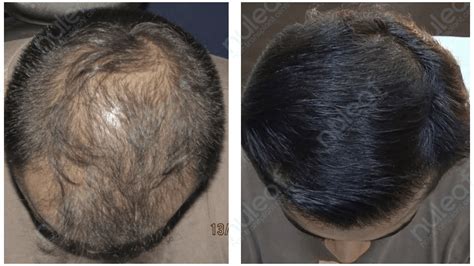 Prp therapy is becoming a popular complement to hair transplants. PRP Hair Treatment: Stunning Result: At Nuleaf Hair ...