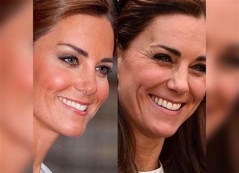 Kate Middleton Nose Job Before And After
