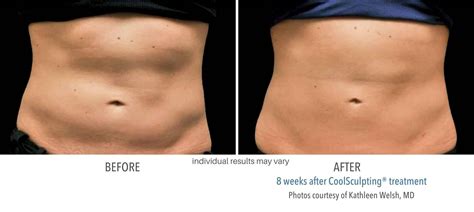 Coolsculpting Before And After Results From Real Patients