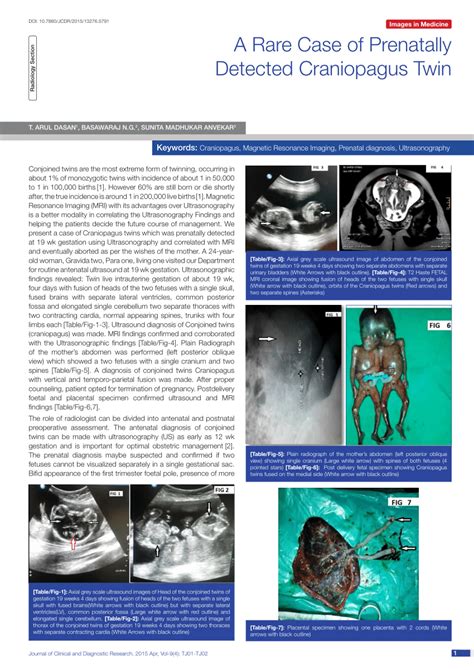 Pdf A Rare Case Of Prenatally Detected Craniopagus Twin