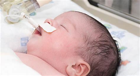 Neumonía Neonatal Asociada A La Ventilación Mecánica Algunos Factores