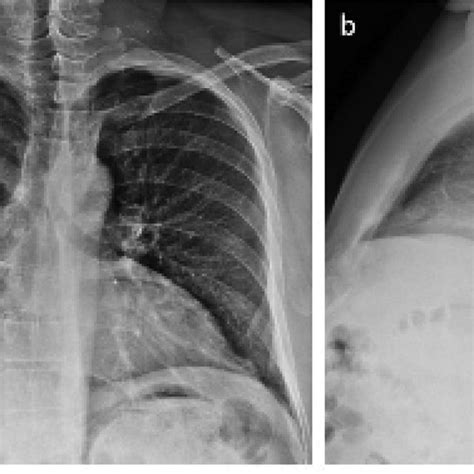 Posteroanterior Pa A And Lateral Views B Of Chest Radiograph