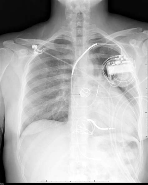 Prosthetic Valve Inside Rvot Conduit Radiology Case