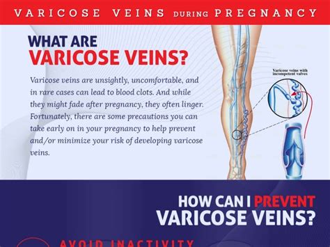 Varicose Veins During Pregnancy