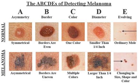 Melanom Rak Kože Uzrok Simptomi I Liječenje Hipokrat Kako