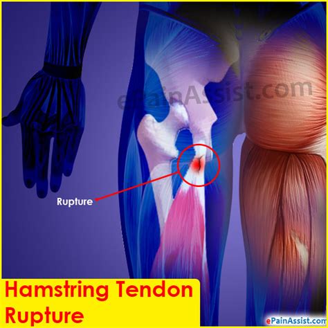 Causes And Symptoms Of Hamstringtendon Rupture