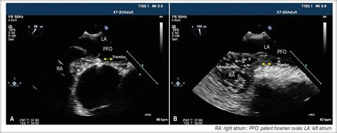 Echocardiographic Evaluation Of Patients With Patent Foramen Ovale And