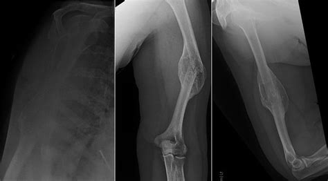 Humeral Shaft Hypertrophic Non Union Mimicking Malignant Lesion Bmj