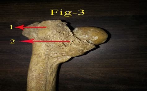 Posterior View Of Left Sided Femur Showing Ossified Fibrous Capsule Of