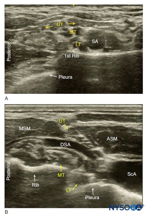 Ultrasound Guided Supraclavicular Brachial Plexus Block Nysora
