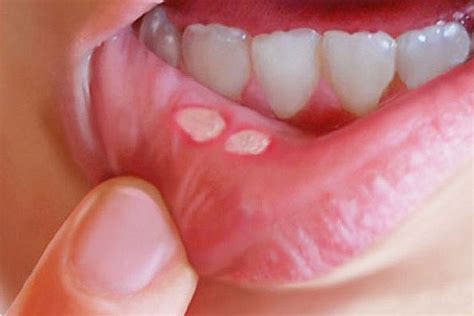 Aftowe Zapalenie Jamy Ustnej Przyczyny Objawy Diagnoza Leczenie