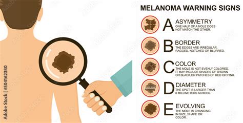 Plakat Diagnosis Of Skin Cancer Melanoma Warning Signs Dermatological