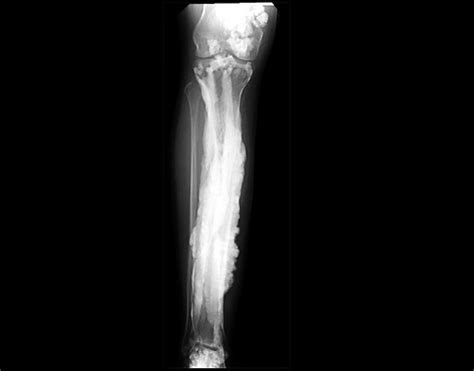 Melorheostosis Bone Disease An X Ray Image Of A Patient Wi Flickr