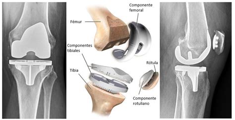 Revisión De La Prótesis De Rodilla Hip And Knee Care