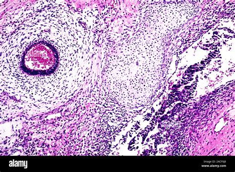 Testicular Cancer Light Micrograph Of A Section Through A Malignant