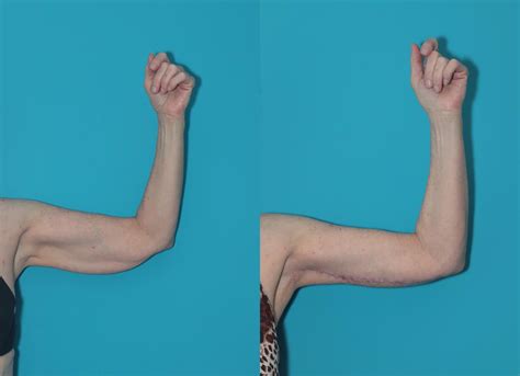 Arm Lift Before And After Pictures Case 324 West Des Moines And Ames