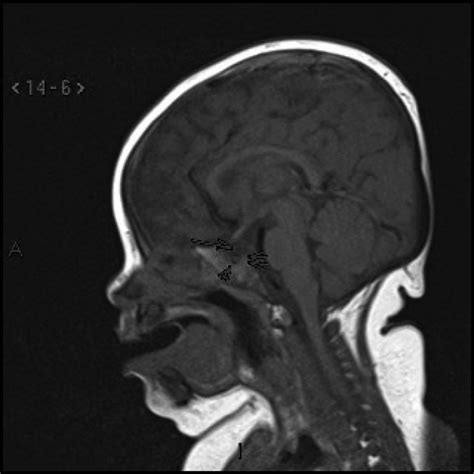 t1 weighted sagittal mri through the pituitary fossa shows a thin download scientific diagram