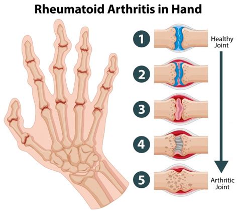 Ejercicios Para La Artritis Reumatoide En Las Manos B Vrogue Co