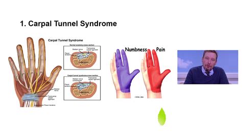 Diabetic Neuropathies By Dr David Webb Youtube