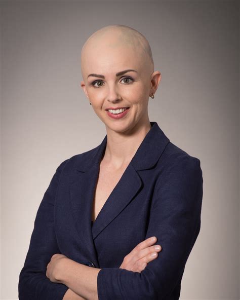 Just Bald Ottawa Woman Comes Clean About Life With Alopecia Cbc News