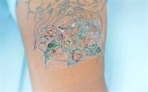 5 Causes Of A Tattoo Rash And How To Treat It 2023